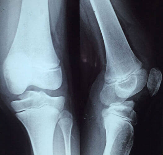 Joint Replacement Clinic Chennai